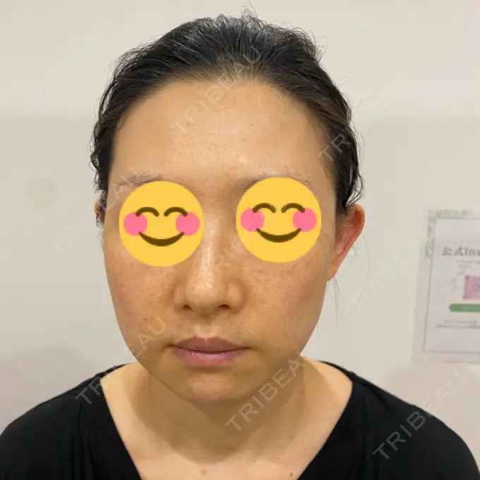 エレクトロポレーション / 毛穴洗浄（ハイドラフェイシャルなど） ミニマムスキンクリニック池袋 BEFORE メイン用