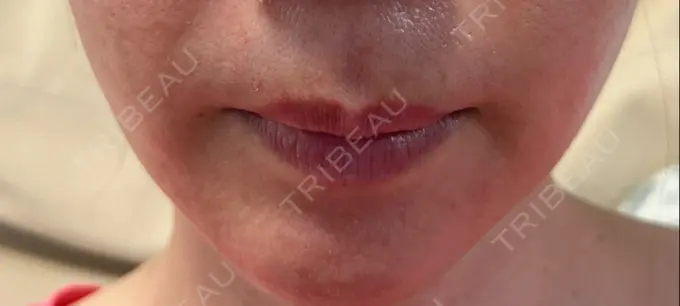 ヒアルロン酸注入（唇） ロレシー美容クリニック 心斎橋駅前院 BEFORE メイン用