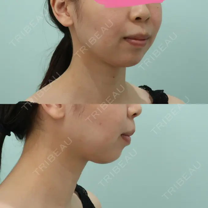 あごプロテーゼ WOM CLINIC GINZA （ワム クリニック ギンザ） BEFORE メイン用