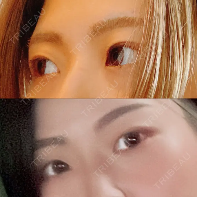 二重切開 みずほクリニック BEFORE メイン用