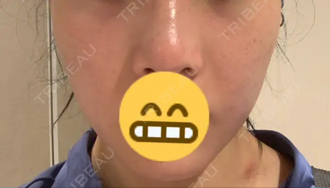 バッカルファット除去 Otus Clinic 【オータスクリニック】 BEFORE メイン用