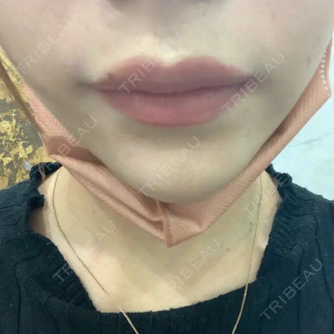 ボトックス（人中） veary clinic BEFORE メイン用