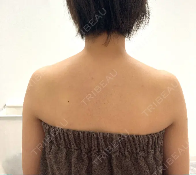 ボトックス（肩） TCB東京中央美容外科 京都駅前院 BEFORE メイン用