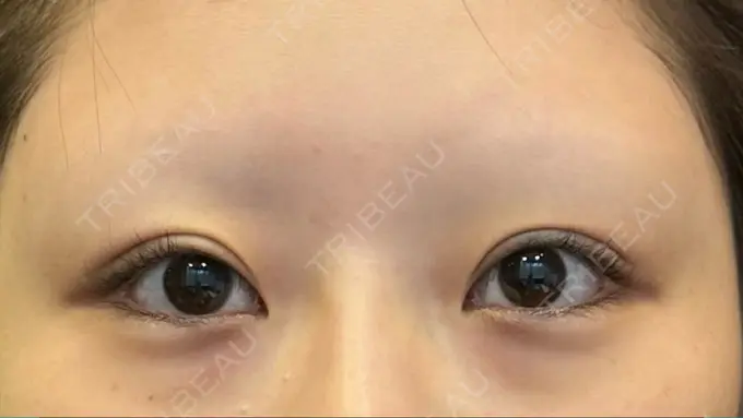 目頭切開 / クマ治療 / 目尻切開 / 下まぶたの脂肪取り / タレ目形成・グラマラスライン（切開） POP美容整形クリニック BEFORE メイン用