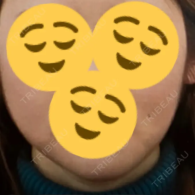 脂肪溶解注射（顔） 表参道ウィズ・クリニック BEFORE メイン用