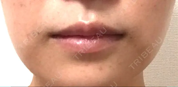 ヒアルロン酸注入（唇） 日本ウェルネス再生クリニック BEFORE メイン用