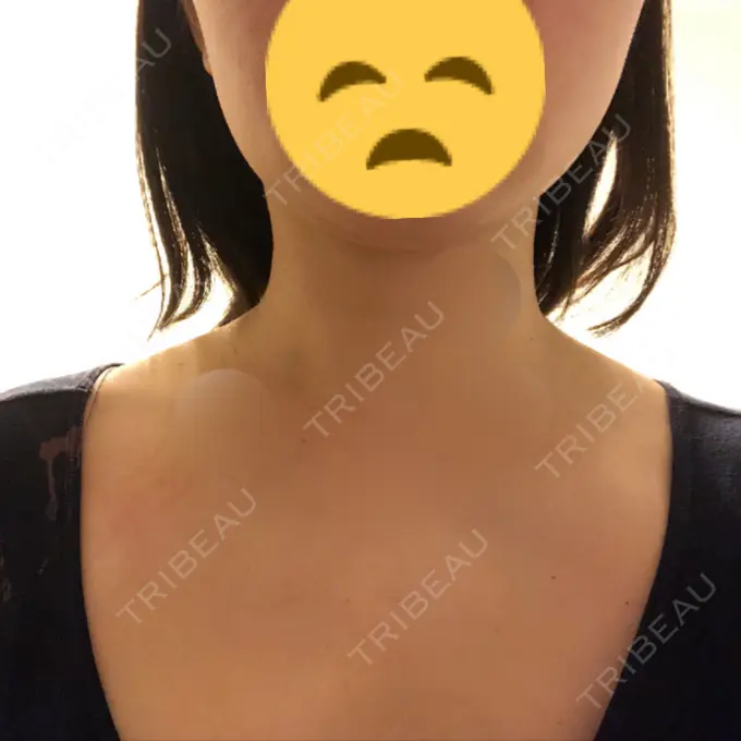 ボトックス（肩） リエンジャン整形外科 江南店 BEFORE メイン用