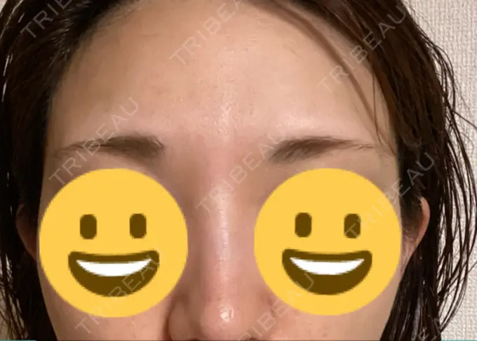 アートメイク（眉） 表参道メディカルクリニック 名古屋院 BEFORE メイン用