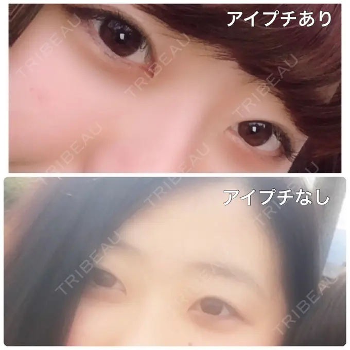 二重埋没 湘南美容クリニック 長野院 BEFORE メイン用