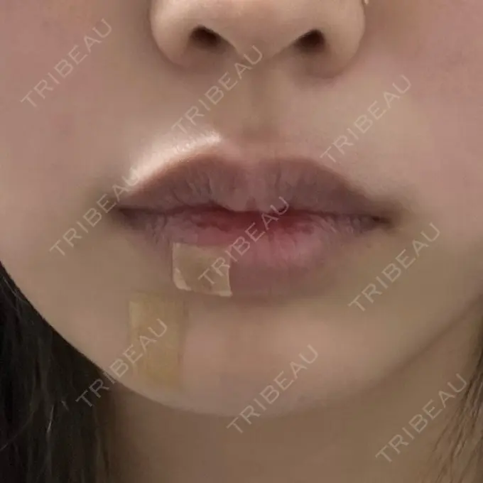 その他（口元） アバント整形外科医院 BEFORE メイン用