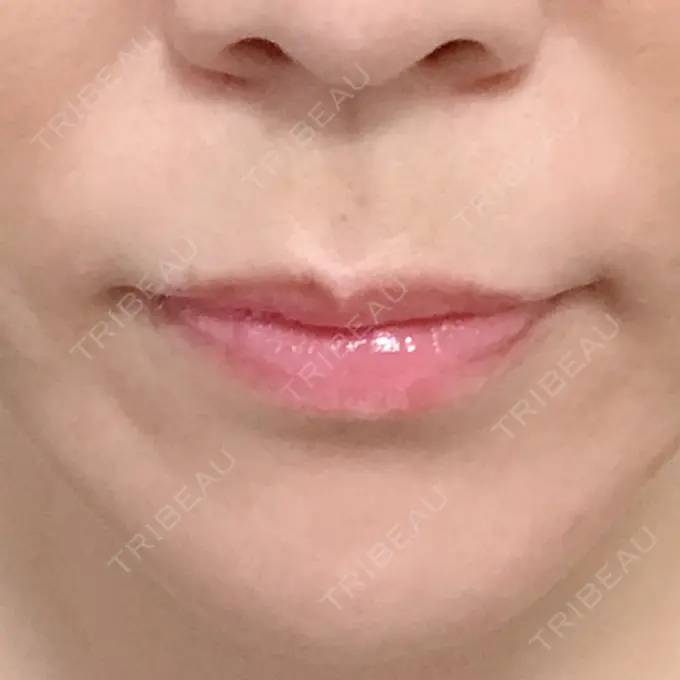 人中短縮 ドクターゴールドマンクリニック 大阪院 BEFORE メイン用