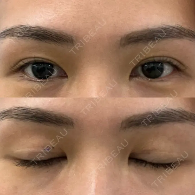 二重埋没 大塚美容形成外科 銀座本院 BEFORE メイン用