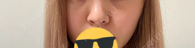 隆鼻術 聖心美容クリニック 福岡院 BEFORE メイン用