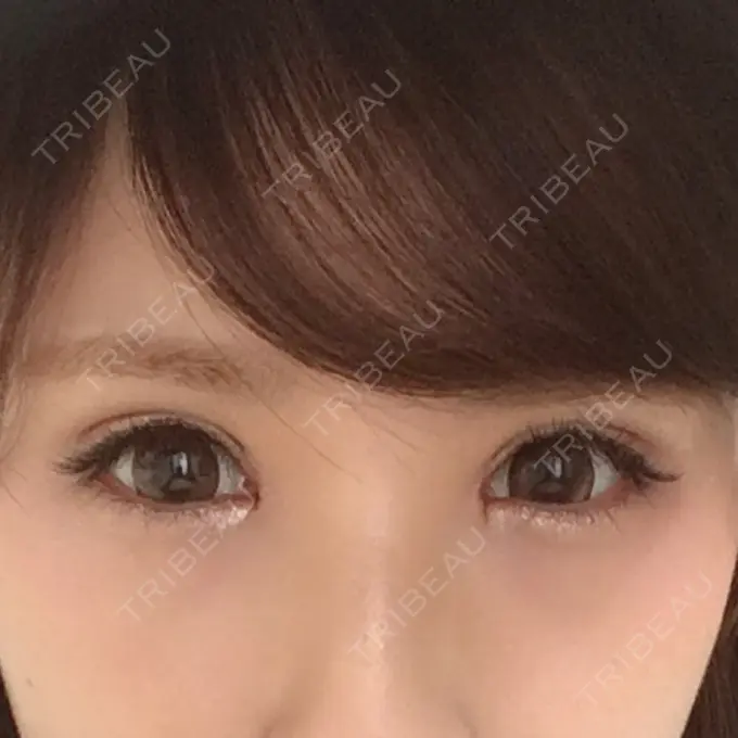 目尻切開 / タレ目形成・グラマラスライン（切開） 品川美容外科 横浜院（※品川スキンクリニック提携） BEFORE メイン用