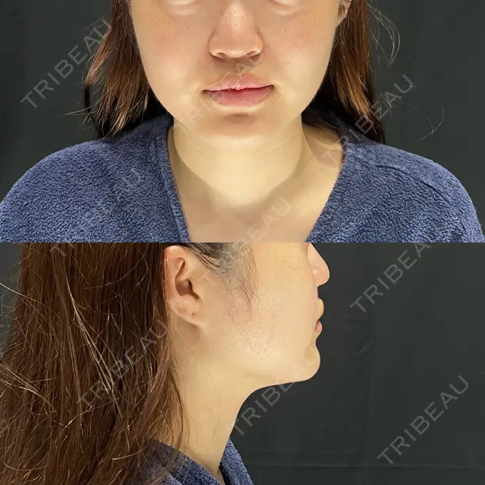 糸リフト / 脂肪吸引（顔） Casa de GRACIA GINZA 【カーサデグラシアギンザ】 BEFORE メイン用