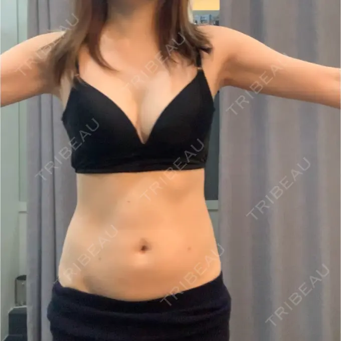 脂肪吸引（二の腕） / 脂肪吸引（お腹） / 脂肪溶解注射（二の腕） / 脂肪溶解注射（お腹） / その他（ボディ） THE SKINNY CLINIC（ザ・スキニークリニック） BEFORE メイン用