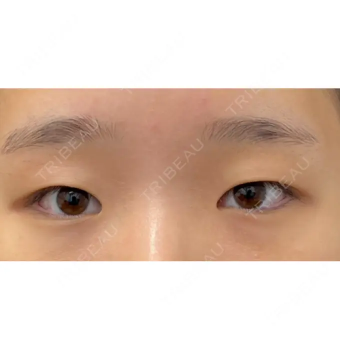 二重埋没 湘南美容クリニック 京都院 BEFORE メイン用