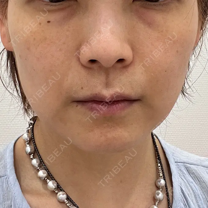 糸リフト 東京シンデレラ美容外科 池袋院 BEFORE メイン用