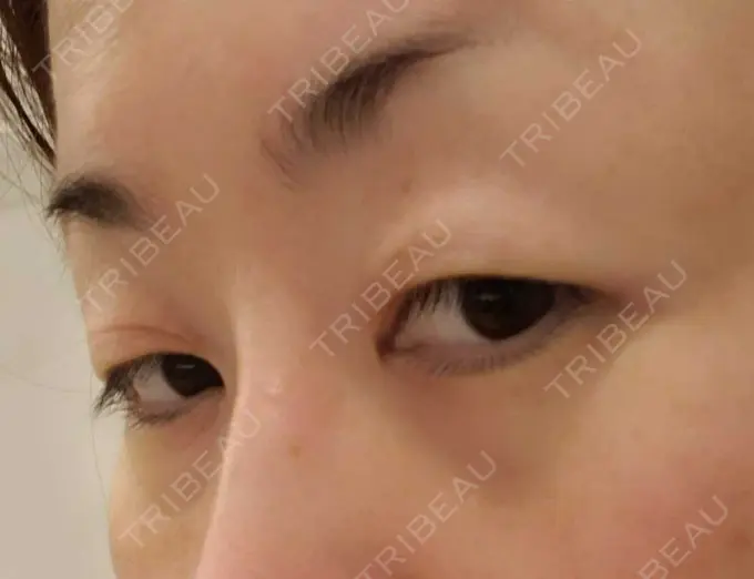 下まぶたたるみ取り / 下まぶたの脂肪取り / その他（目元） エースクリニック 名古屋院 BEFORE メイン用