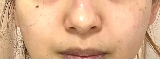 毛穴洗浄（ハイドラフェイシャルなど） KM新宿クリニック BEFORE メイン用