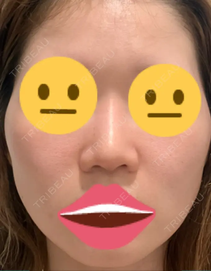 隆鼻術 / ボトックス（エラ・小顔） TCB東京中央美容外科 福岡博多院 BEFORE メイン用