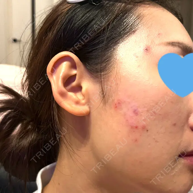 ピコレーザートーニング（美白・肝斑） / ピコフラクショナルレーザー（毛穴・ニキビ跡） ルラ美容クリニック 福岡本院 BEFORE メイン用