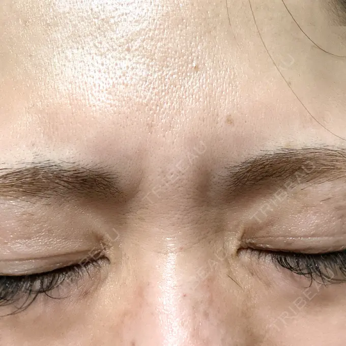 ボトックス（眉間） / その他（鼻） TCB東京中央美容外科 青森院 BEFORE メイン用