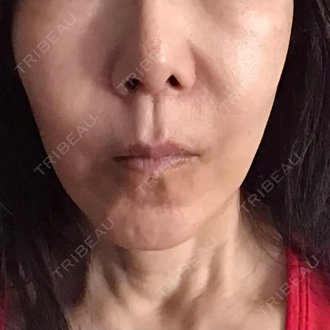 脂肪溶解注射（顔） 表参道ウィズ・クリニック BEFORE メイン用