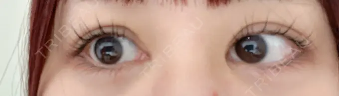 二重埋没 / 目頭切開 Brandnew Beauty Clinic BEFORE メイン用