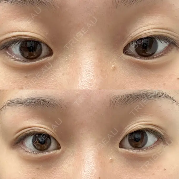 二重埋没 湘南美容クリニック 京都院 BEFORE メイン用