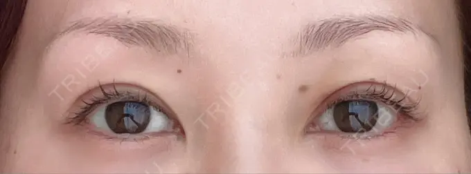 ピコレーザートーニング（美白・肝斑） / ピコスポット 日比谷セントラルクリニック BEFORE メイン用