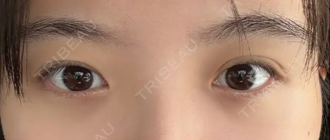 二重埋没 / 目頭切開 アマソラクリニック BEFORE メイン用