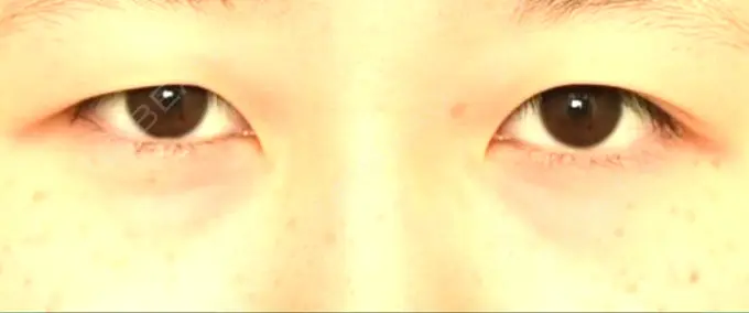 二重埋没 札幌ル・トロワ ビューティクリニックVogue BEFORE メイン用