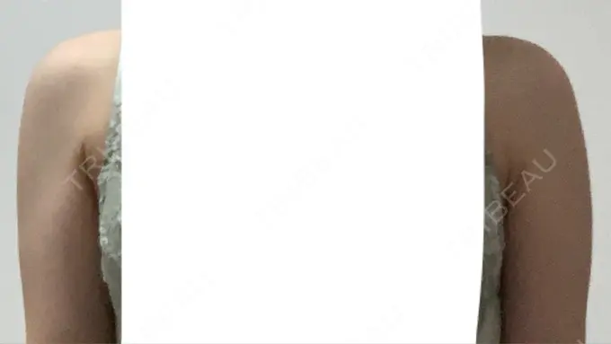 脂肪溶解注射（二の腕） プラデン整形外科 BEFORE メイン用