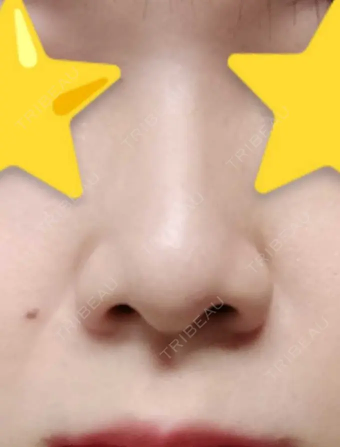 小鼻縮小（切開） 宇都宮ひふ科形成外科 BEFORE メイン用