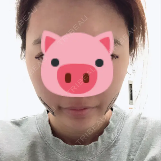 バッカルファット除去 / 脂肪吸引（顔） / 目尻切開 / 水光注射（ハリ・美肌） / ヒアルロン酸注入（あご） / ボトックス（エラ・小顔） / ボトックス（口角） / 白玉点滴・注射 / その他（肌） エートップ美容整形外科 BEFORE メイン用