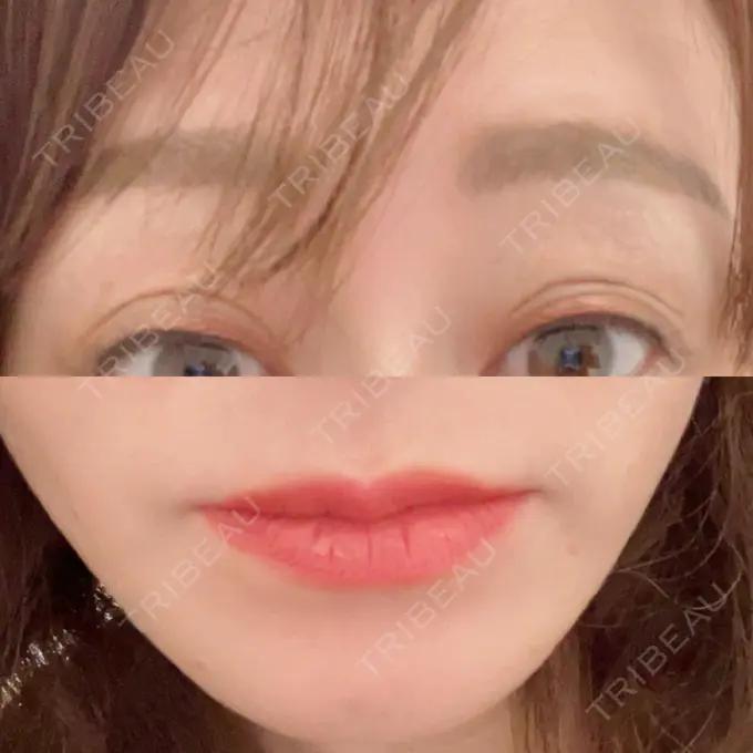 ボトックス（あご） / ボトックス（タレ目） / ボトックス（眉間） / ボトックス（目尻） DMTC CLINIC 日本橋院 BEFORE メイン用