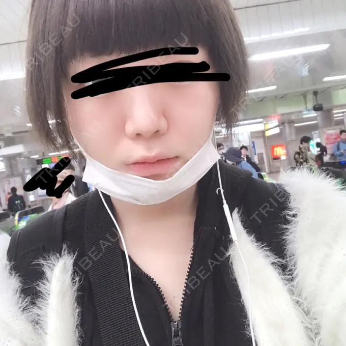 隆鼻術 / 鼻中隔延長（切開） / 鼻孔縁挙上 プリモ麻布十番クリニック BEFORE メイン用