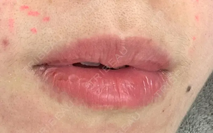 アートメイク（唇） Tokyo Tensei Clinic 新宿院 BEFORE メイン用