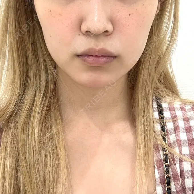 ボトックス（エラ・小顔） 東京シンデレラ美容外科 池袋院 BEFORE メイン用