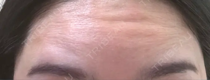 ボトックス（額） 湘南美容クリニック 大阪あべの院 BEFORE メイン用