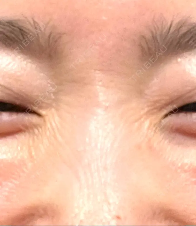 その他（目元） 湘南美容クリニック 大阪あべの院 BEFORE メイン用