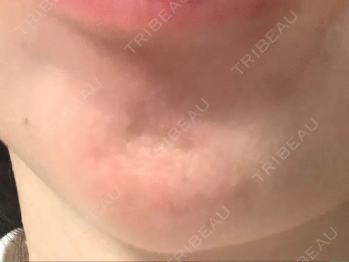 ボトックス（あご） 湘南美容クリニック 大阪あべの院 BEFORE メイン用