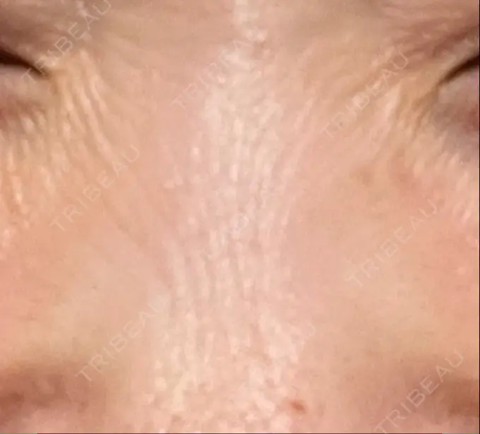 その他（鼻） 湘南美容クリニック 大阪あべの院 BEFORE メイン用