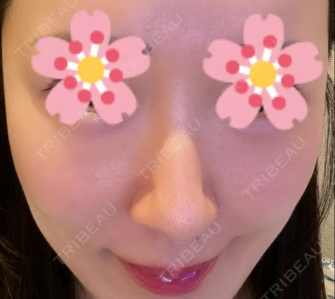 ヒアルロン酸注入（頬） 湘南美容クリニック 宇都宮院 BEFORE メイン用