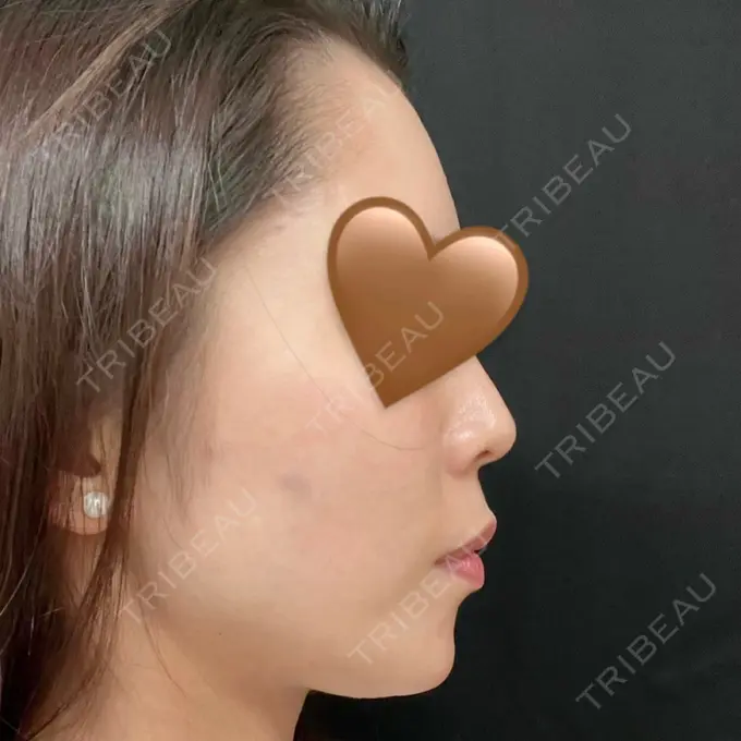 ヒアルロン酸注入（あご） / ボトックス（エラ・小顔） / ヒアルロン酸注入（頬） / ヒアルロン酸注入（こめかみ） / 美容点滴・美容注射（ダイエット） 湘南美容クリニック 京都院 BEFORE メイン用