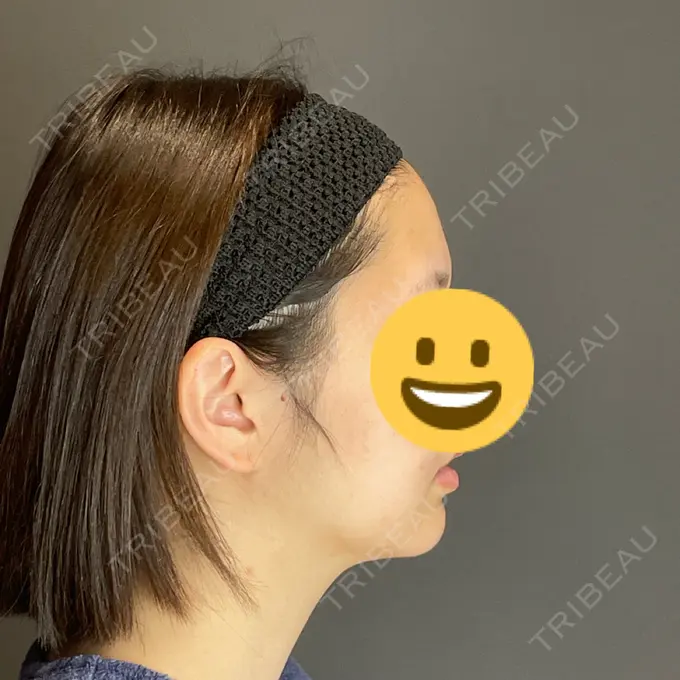 糸リフト / 脂肪吸引（顔） Casa de GRACIA GINZA 【カーサデグラシアギンザ】 BEFORE メイン用