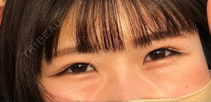 クマ治療 / 下まぶたの脂肪取り Brandnew Beauty Clinic BEFORE メイン用