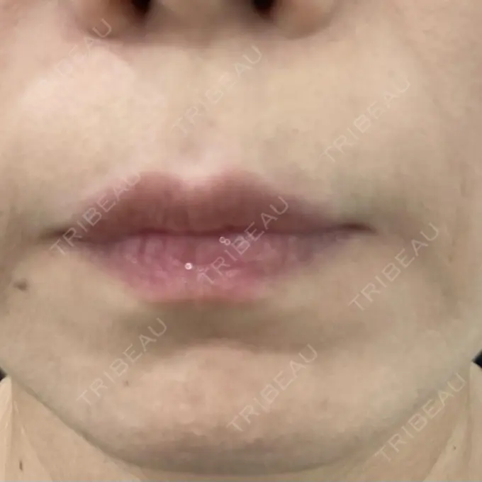 ボトックス（人中） veary clinic BEFORE メイン用