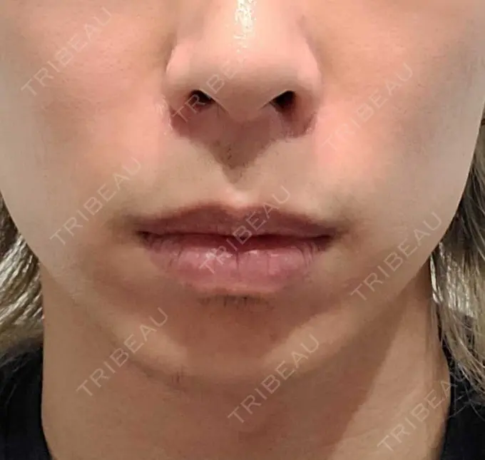 ヒアルロン酸注入（あご） Otus Clinic 【オータスクリニック】 BEFORE メイン用